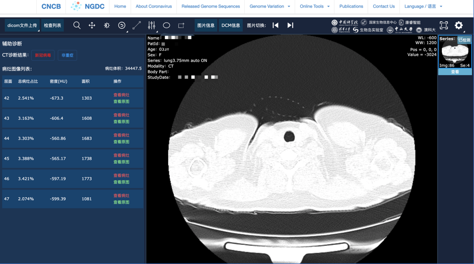 AI Diagnosis System Offering Powerful Support for International Prevention and Control of COVID-19